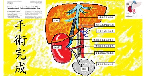 亞洲第一例「分肝種腎」器官移植！成人腎臟種到8歲女童肝臟，脫離洗腎人生