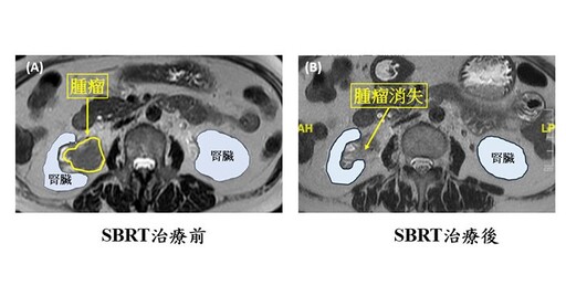 無痛性血尿，小心腎盂泌尿上皮癌找上門！立體定位放射治療消除腫瘤