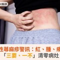 慢性自發性蕁麻疹警訊：紅、腫、癢逾六週！「三要、一不」清零病灶