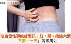 慢性自發性蕁麻疹警訊：紅、腫、癢逾六週！「三要、一不」清零病灶