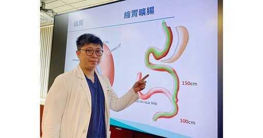 病態性肥胖減重「縮胃曠腸手術」是什麼？減重成效、優點一次看