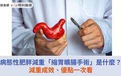 病態性肥胖減重「縮胃曠腸手術」是什麼？減重成效、優點一次看