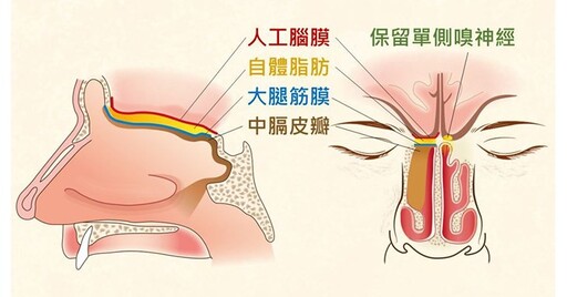 顱底嗅覺母神經細胞瘤害鼻塞與鼻膿！四手摘除顱底腫瘤，保留嗅覺