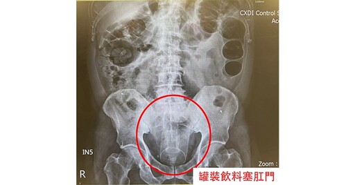 險！肛門塞長13公分飲料罐，「這動作」成功拆彈，避免腸子壞死