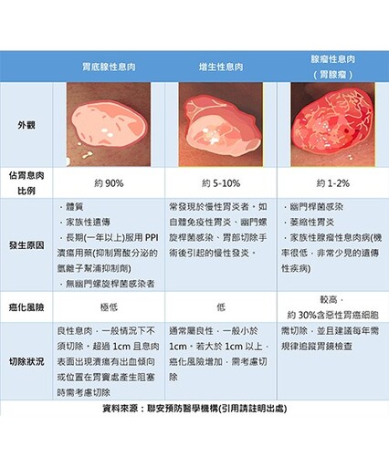 胃息肉＝胃癌？胃息肉該不該切除？哪種胃息肉該切除？