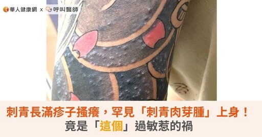 刺青長滿疹子搔癢，罕見「刺青肉芽腫」上身！竟是「這個」過敏惹的禍