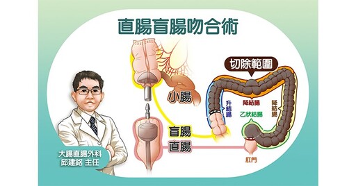 她為減肥竟日吞百顆瀉藥30年，腸道完全失能！醫師療心治腸換新人生