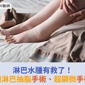 淋巴水腫有救了！新式減積淋巴抽脂手術、超顯微手術助改善