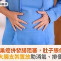 8旬婦卵巢癌併發腸阻塞，肚子脹像顆球！大腸支架置放助消氣、排便