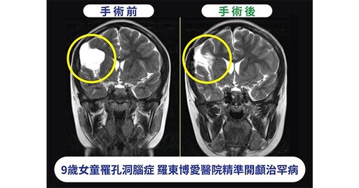 9歲女童罹罕病孔洞腦症，癲癇頻發！開顱手術3D導航，精準安全