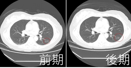 7旬阿嬤肺結節2年大一倍，沒有不適？！微創手術切片檢查，竟是早期肺腺癌