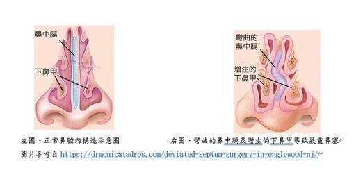 噴嚏打不完、鼻水流不停？過敏性鼻炎又發作！過敏性鼻炎的三階段處理