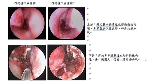 噴嚏打不完、鼻水流不停？過敏性鼻炎又發作！過敏性鼻炎的三階段處理