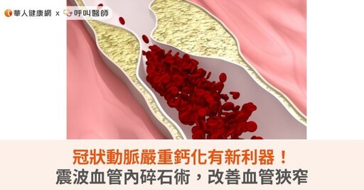 冠狀動脈嚴重鈣化有新利器！震波血管內碎石術，改善血管狹窄