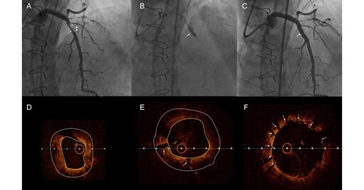 冠狀動脈嚴重鈣化有新利器！震波血管內碎石術，改善血管狹窄