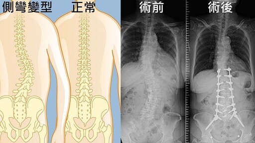 脊椎退化變型害腰酸背痛、舉步維艱！AI微創以管窺天，顯微助脊椎截彎取直