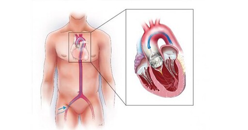 重度主動脈瓣膜閉鎖不全害胸悶、走路喘！微創瓣膜手術傷口小、恢復快
