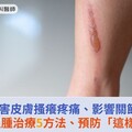 蟹足腫害皮膚搔癢疼痛、影響關節活動！蟹足腫治療5方法、預防「這樣做」