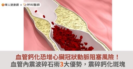 血管鈣化恐增心臟冠狀動脈阻塞風險！血管內震波碎石術3大優勢，震碎鈣化斑塊