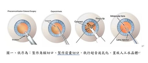 白內障手術新科技！Zepto引導視軸中心定位前囊切口術優點一次看