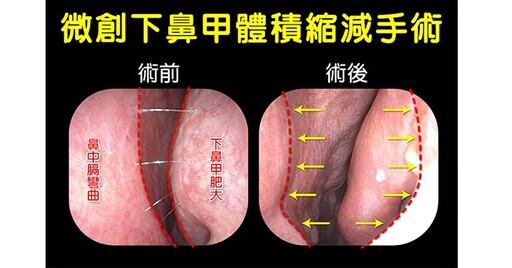 長期鼻過敏害下鼻甲肥厚！阻斷後鼻神經縮減下鼻甲，打鼾女戰勝鼻過敏