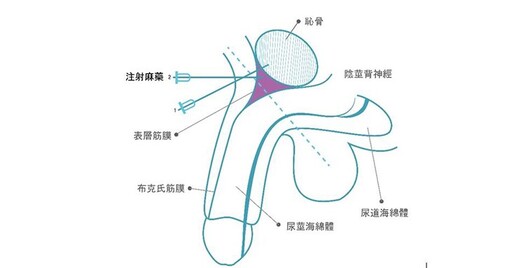 寒假男童包皮環切手術掀熱潮！醫：「陰莖神經阻斷術」止痛、減緩焦慮