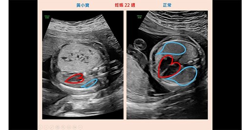 罕見胎兒肺腫瘤：先天性肺部呼吸道畸形恐造成胎兒水腫！北榮團隊成功搶救