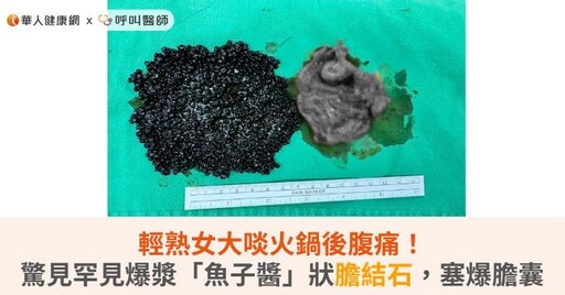 輕熟女大啖火鍋後腹痛！醫驚見罕見爆漿「魚子醬」狀膽結石，塞爆膽囊