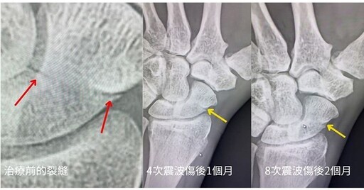 舟狀骨骨折一定要開刀嗎？會自己癒合嗎？不開刀、不打石膏治療新選擇