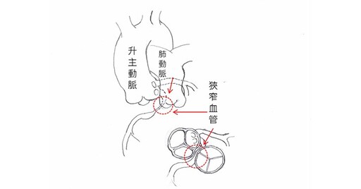 右冠狀動脈出口狹窄嚴重恐致心跳停止！達文西冠狀動脈繞道手術解除大患