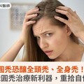 圓禿恐釀全頭禿、全身禿！認識圓禿治療新利器，重拾自信心