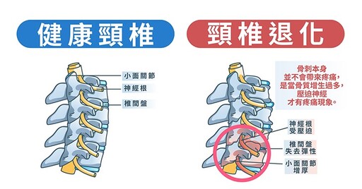 頸椎生骨刺壓迫神經，輕則麻痛，重恐癱瘓！內視鏡神經孔減壓，精準除骨刺