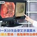 婦一天10次血便又滲漏糞水，竟是潰瘍性腸炎惹禍！進階藥物治療帶來新曙光