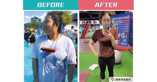 傷口不癒合、憂鬱失眠，恐是肥胖惹的禍！個人化減重管理，防慢性疾病發生