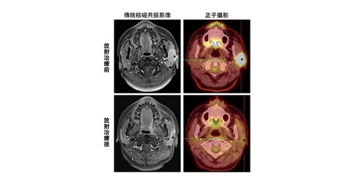 精準醫療再突破！長庚研究：正子攝影可準確評估唾液腺癌放射治療效果