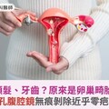 腫瘤竟藏頭髮、牙齒？原來是卵巢畸胎瘤作怪！單孔腹腔鏡無痕剝除近乎零疤痕
