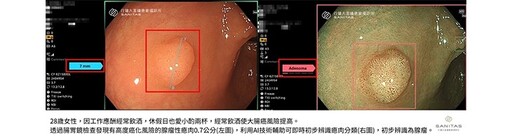 腺瘤性瘜肉變成大腸癌風險高！28歲女業務應酬拚酒，大腸鏡揪出高風險瘜肉