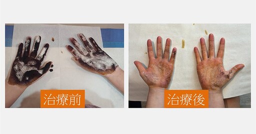 青春期少女手汗、腋下異味好困擾！無創微波治療4大優點，改善多汗、減少狐臭