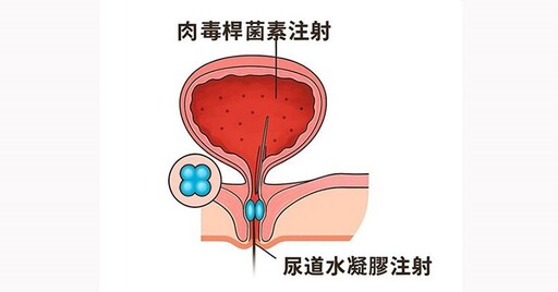 混合型尿失禁治療新武器！尿道水凝膠填充加肉毒桿菌注射，擺脫困擾