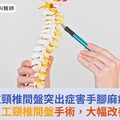 低位頸椎間盤突出症害手腳麻痛！微創人工頸椎間盤手術，大幅改善生活
