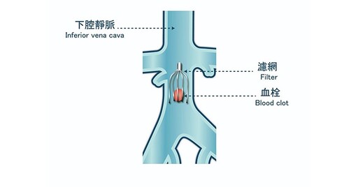 深層靜脈栓塞恐造成肺栓塞！醫：深層靜脈栓塞與「菲爾紹三要素」有關