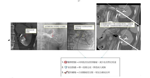 腫瘤治療新時代來臨！北榮引進新式複合式血管攝影暨CT，腫瘤消融更精準
