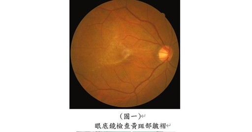 黃斑部皺褶易導致視力模糊、扭曲變形！北榮找出黃斑部皺褶視力惡化關鍵