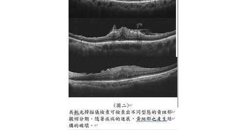 黃斑部皺褶易導致視力模糊、扭曲變形！北榮找出黃斑部皺褶視力惡化關鍵