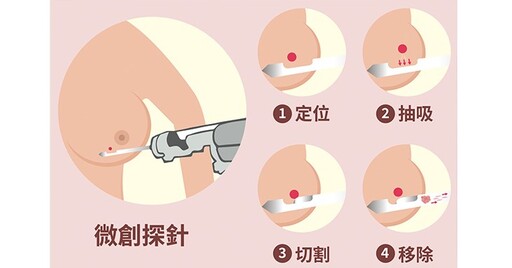 乳房良性腫瘤治療新選擇！乳房微創手術+真空輔助切除，保留美觀與健康