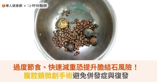 過度節食、快速減重恐提升膽結石風險！腹腔鏡微創手術避免併發症與復發
