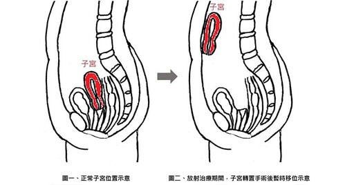 全台首例!「子宮轉置手術」為直腸癌女患者保留生育希望,成果登國際期刊