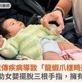 罕見遺傳疾病導致「龍蝦爪樣畸形」！精準醫療助女嬰擺脫三根手指，擁有健康十指