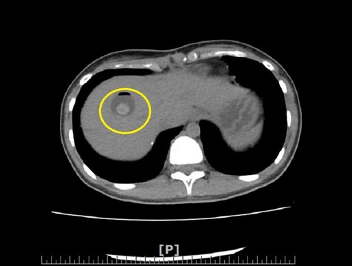 少女罹膽道囊腫致肝內結石 經皮穿肝體外取石免開刀