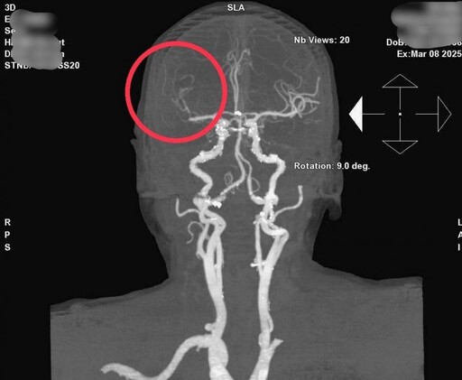 動脈取栓治療 南投醫院成功搶救腦中風